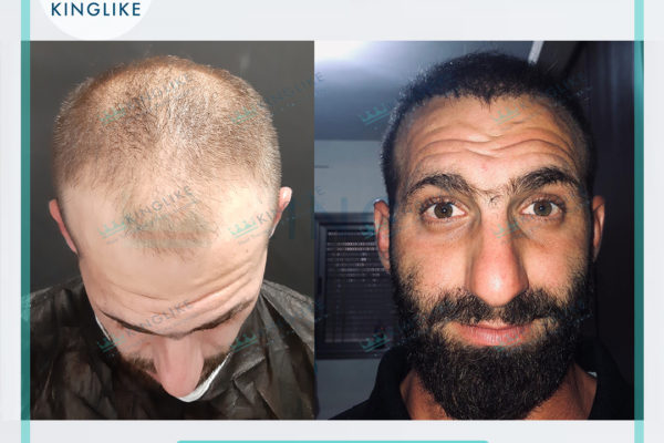 KINGLIKE_HAIR_TRANSPLANT_before&after_84444