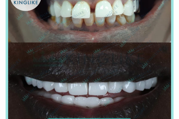 kinglike_dental_treatment_zircoun_2021