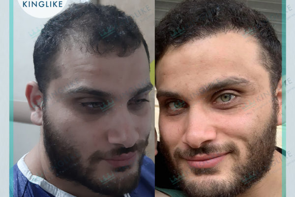 KINGLIKE_HAIR_TRANSPLANT_before&after_858