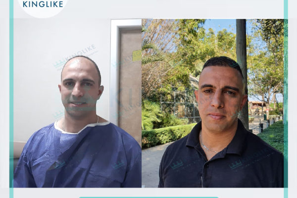 KINGLIKE_HAIR_TRANSPLANT_before&after_8958